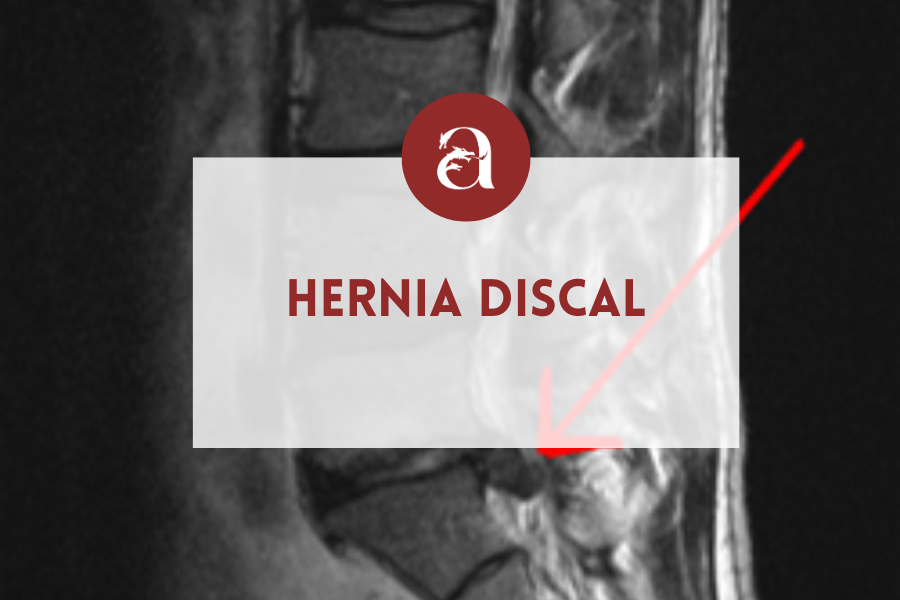 hernia discal protrusión